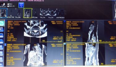 脊椎分離すべり症の私のMRI画像!